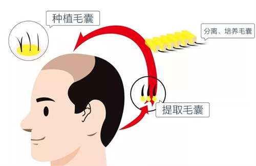 石家庄植发手术的收费标准是什么?透视头顶之美投入成本分析插图 石家庄植发手术的收费标准是什么?透视头顶之美投入成本分析插图