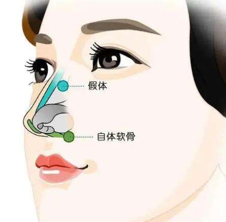 驼峰鼻矫正手术多少钱?一般在7800元至35,000元左右插图1 驼峰鼻矫正手术多少钱?一般在7800元至35,000元左右插图1