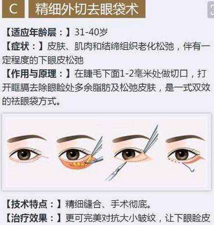 山东做手术去眼袋要花多少钱?价格参考是3000到800元不等插图 山东做手术去眼袋要花多少钱?价格参考是3000到800元不等插图