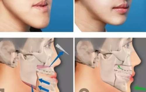 反颌矫正手术多少钱插图 反颌矫正手术多少钱插图