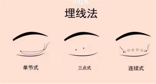 埋线双眼皮比全切双眼皮便宜吗?价格不高还不开刀插图 埋线双眼皮比全切双眼皮便宜吗?价格不高还不开刀插图