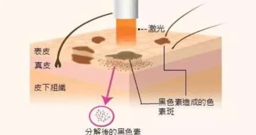 激光祛斑的价格一般是多少啊?范围在4200元至28,900元左右插图1 激光祛斑的价格一般是多少啊?范围在4200元至28,900元左右插图1
