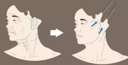 青岛拉皮手术哪里好?照着选不出错插图1 青岛拉皮手术哪里好?照着选不出错插图1