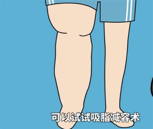 大腿吸脂价格贵吗?术后风险有哪些?2026价格表插图1 大腿吸脂价格贵吗?术后风险有哪些?2026价格表插图1