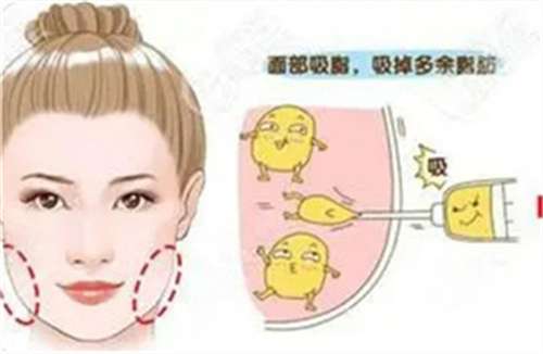 面部吸脂多少钱一个部位?吸脂有风险吗?科普讲解插图2 面部吸脂多少钱一个部位?吸脂有风险吗?科普讲解插图2