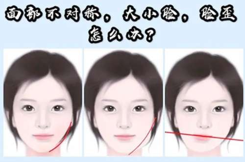 大小脸矫正手术需要多少钱插图1