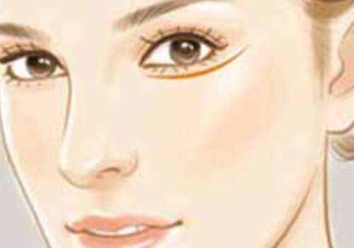 膨体隆鼻多少钱?好处有哪些?护理知识解答插图1 膨体隆鼻多少钱?好处有哪些?护理知识解答插图1