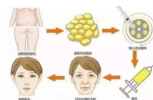 自体脂肪填充一次多少钱?收费清单预览,看细节插图1 自体脂肪填充一次多少钱?收费清单预览,看细节插图1
