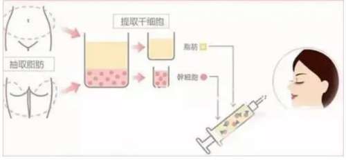法令纹脂肪填充需要多少钱?价格大概3000元到8000元不等插图1 法令纹脂肪填充需要多少钱?价格大概3000元到8000元不等插图1