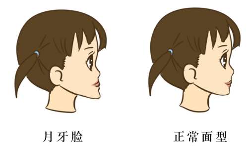 地包天下颌骨矫正手术多少钱插图1 地包天下颌骨矫正手术多少钱插图1