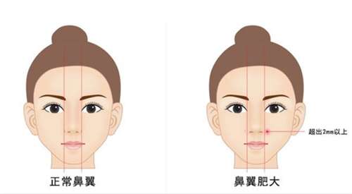 鼻翼缩小手术需要多少钱？收费详情介绍，预览插图