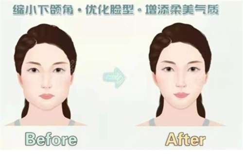 上海下颌角整形多少钱?专家全面解析费用构成插图3 上海下颌角整形多少钱?专家全面解析费用构成插图3