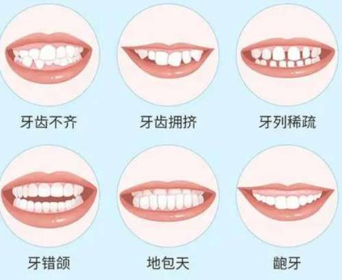 地包天矫正一般费用是多少插图