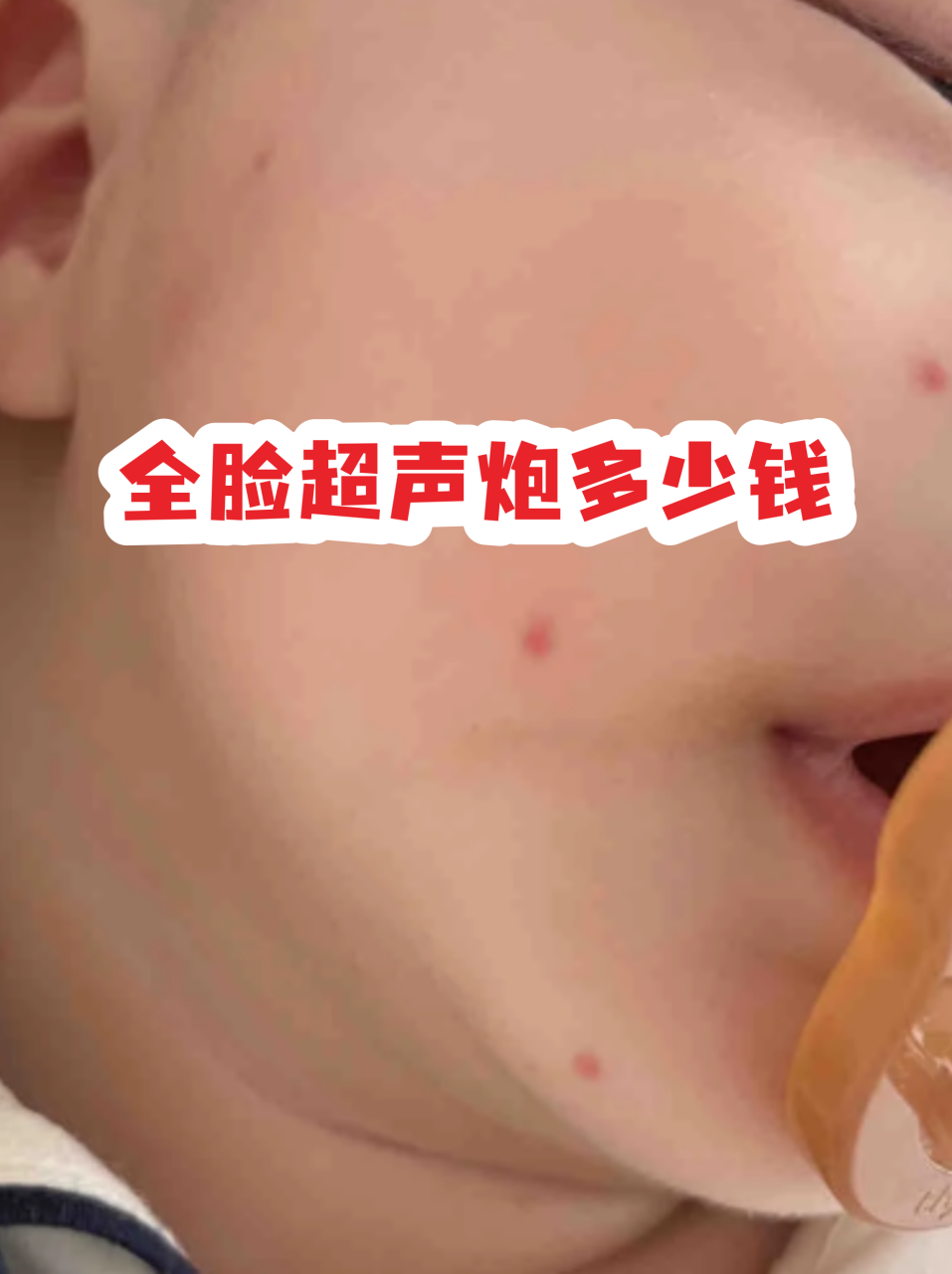 北京超声炮全脸价格多少钱？超声炮面部紧致护理最新费用插图2