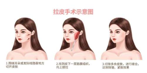 面部提升紧致多少钱？价格大致在12,000元至78,000元插图1