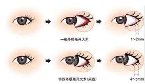 开眼角大概多少钱插图1 开眼角大概多少钱插图1