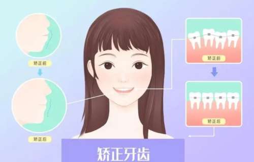 矫正嘴凸大概要多少钱?一般是在6000元到3万元插图 矫正嘴凸大概要多少钱?一般是在6000元到3万元插图