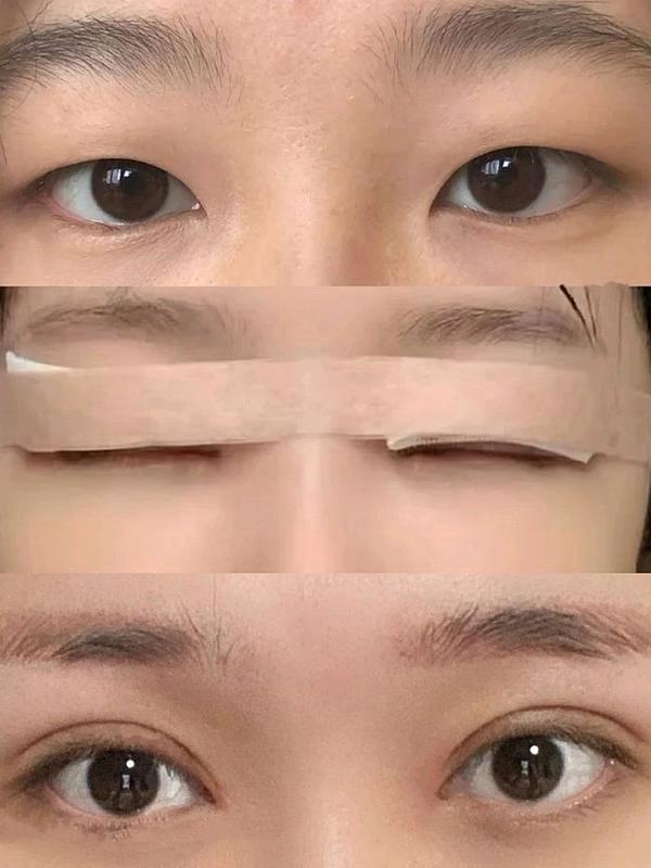 广州双眼皮修复多少钱?插图2 广州双眼皮修复多少钱?插图2
