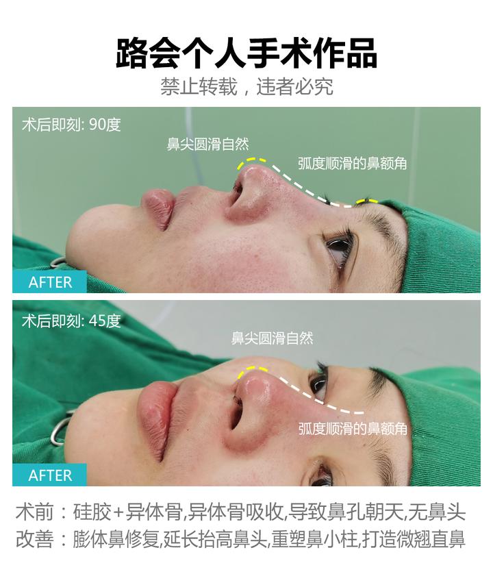 隆鼻假体取出需要多少钱?不同地区医院隆鼻假体取出手术价格差异插图1 隆鼻假体取出需要多少钱?不同地区医院隆鼻假体取出手术价格差异插图1