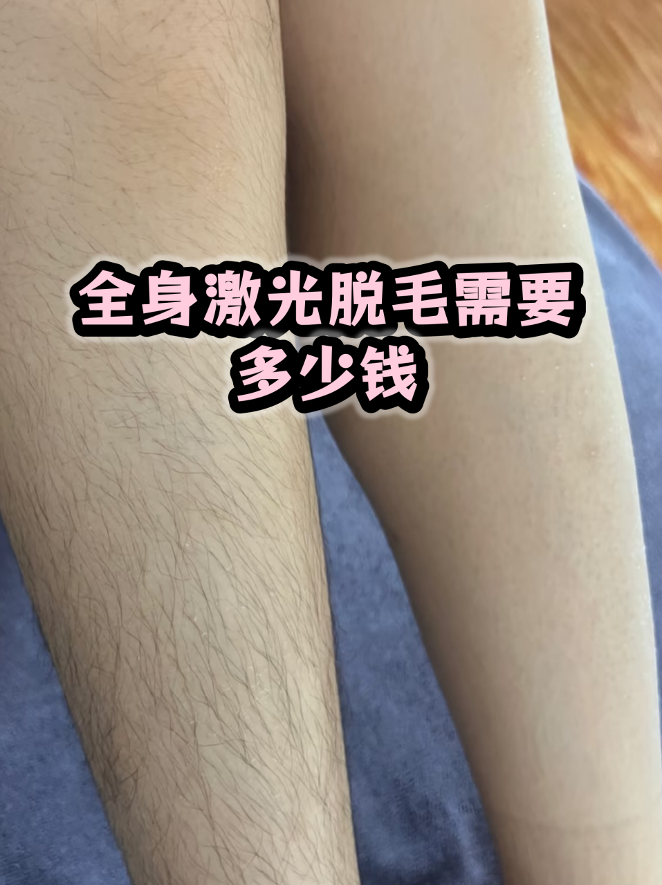 杭州激光脱毛价格多少钱?杭州专业激光脱毛服务费用及效果插图2 杭州激光脱毛价格多少钱?杭州专业激光脱毛服务费用及效果插图2