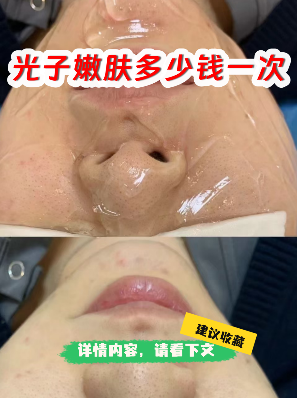 南京做一次超光子嫩肤价格多少钱?插图1 南京做一次超光子嫩肤价格多少钱?插图1