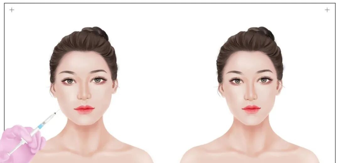 杭州瘦脸针价格要要多少钱？瘦脸针最新费用及效果插图2