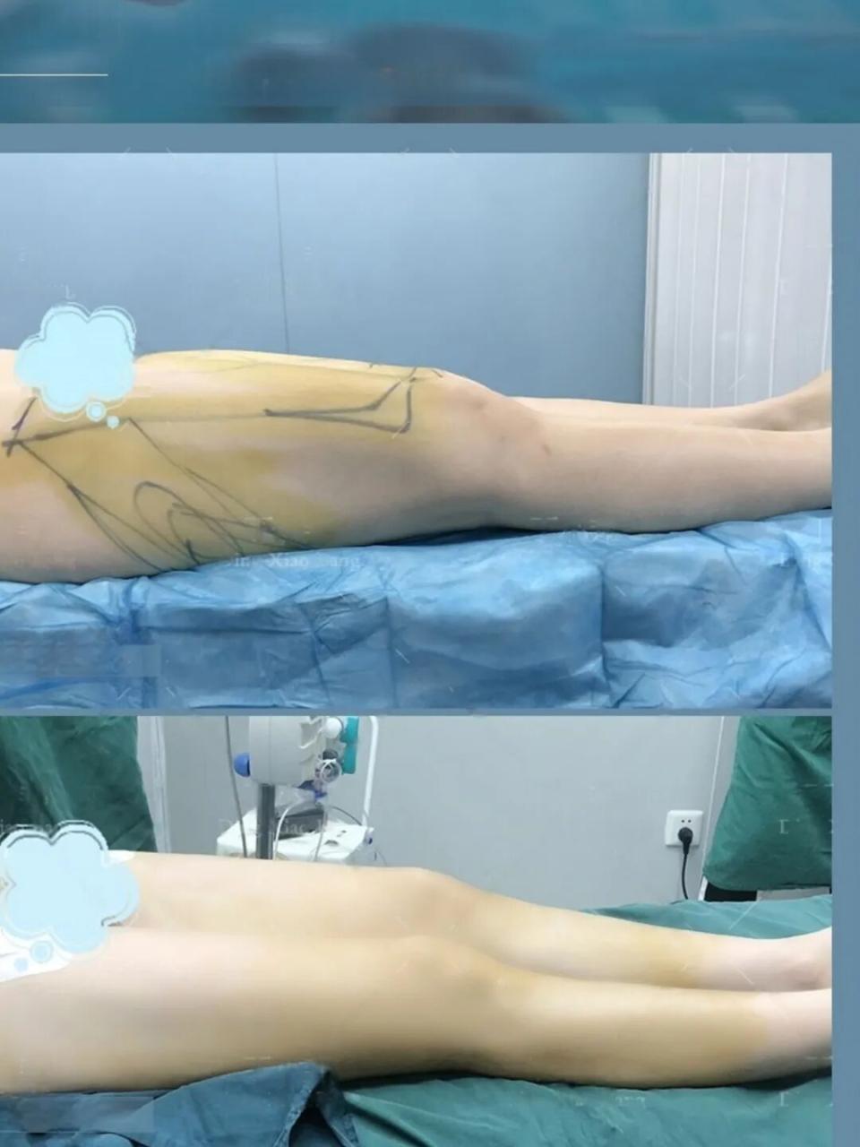 杭州大腿吸脂价格多少钱?大腿吸脂手术费用及效果怎么样插图 杭州大腿吸脂价格多少钱?大腿吸脂手术费用及效果怎么样插图