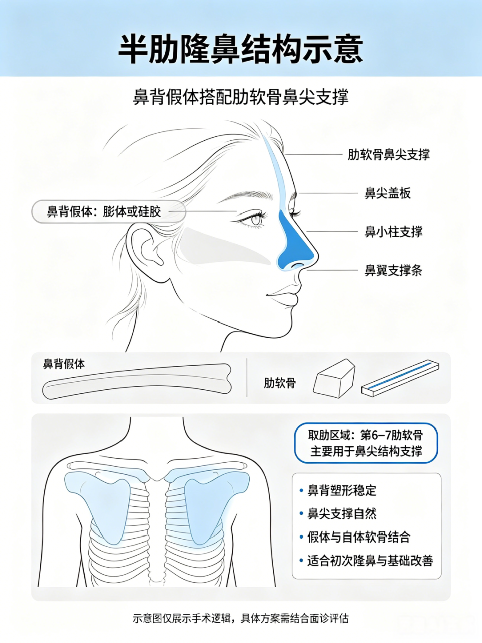 杭州肋软骨隆鼻价格多少钱?影响价格的因素有哪些插图 杭州肋软骨隆鼻价格多少钱?影响价格的因素有哪些插图