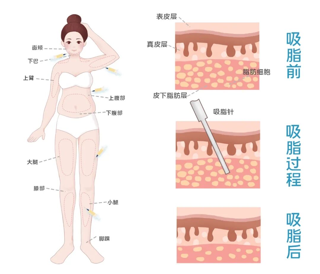 杭州全身吸脂价格多少钱?全身吸脂手术费用及注意事项插图1 杭州全身吸脂价格多少钱?全身吸脂手术费用及注意事项插图1