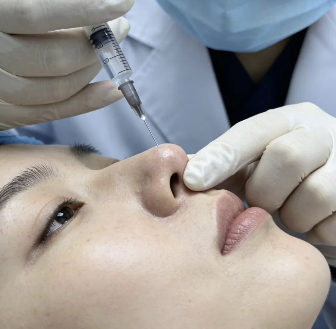 杭州鼻修复手术价格多少钱?如何选择性价比高的鼻修复医院?插图2 杭州鼻修复手术价格多少钱?如何选择性价比高的鼻修复医院?插图2