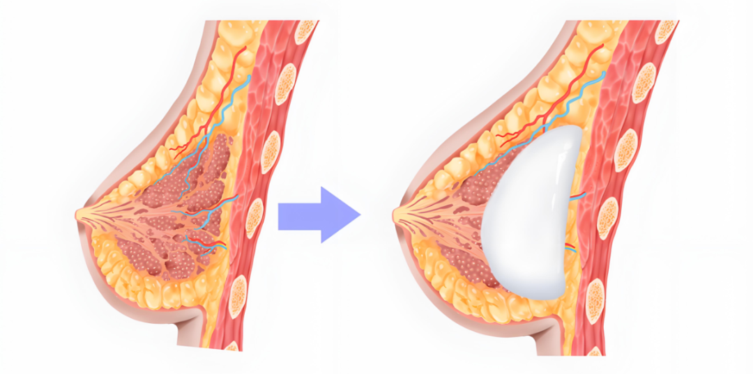 乳房切除后可以做假体隆胸吗?乳房假体对人体有害吗?插图 乳房切除后可以做假体隆胸吗?乳房假体对人体有害吗?插图