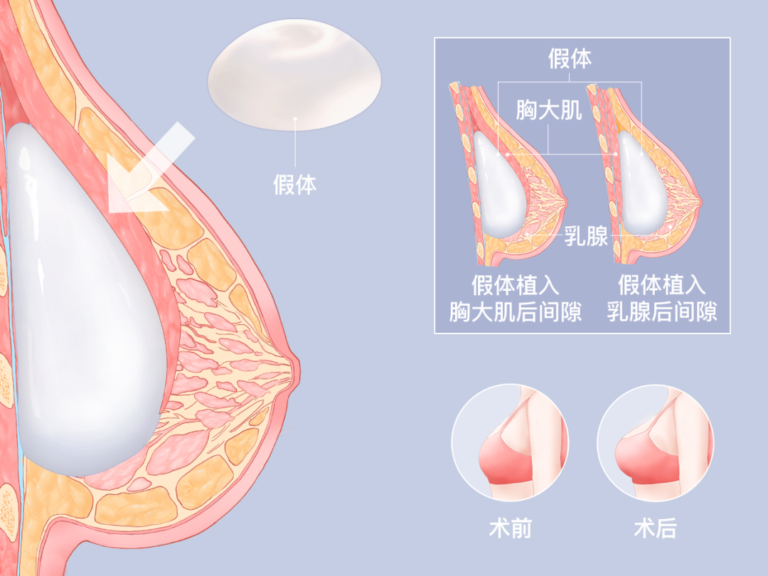 假体隆胸会不会移位?假体隆胸多久才能摸揉?插图 假体隆胸会不会移位?假体隆胸多久才能摸揉?插图
