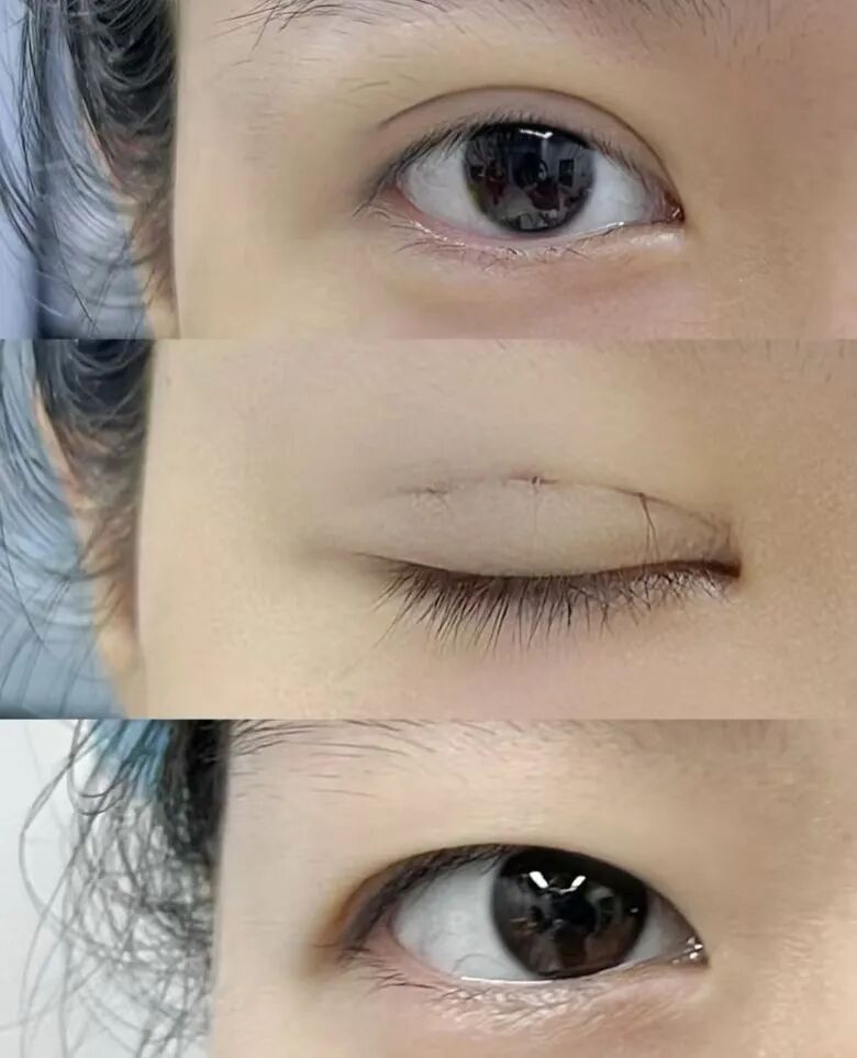 武汉双眼皮微创多少钱?微创双眼皮是什么?插图 武汉双眼皮微创多少钱?微创双眼皮是什么?插图
