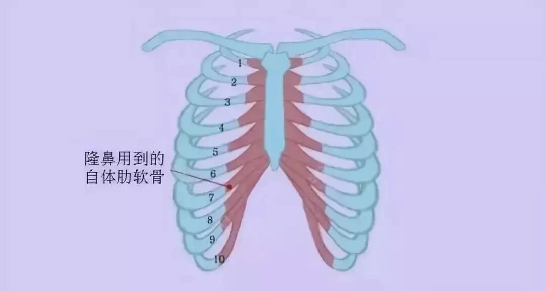 南京肋软骨隆鼻价格多少钱?进行肋软骨移植隆鼻手术大概需要多少钱插图1 南京肋软骨隆鼻价格多少钱?进行肋软骨移植隆鼻手术大概需要多少钱插图1