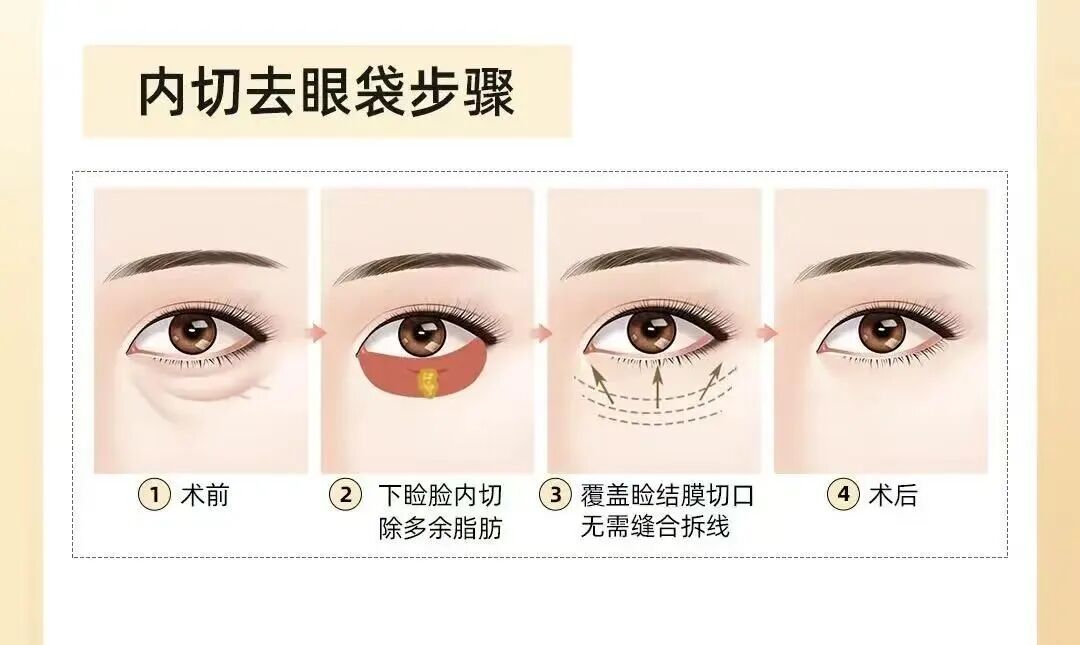 南京内切去眼袋价格多少钱?内切去眼袋手术费用及注意事项插图 南京内切去眼袋价格多少钱?内切去眼袋手术费用及注意事项插图