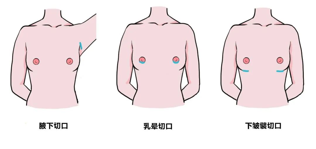 假体隆胸恢复期过后会缩小吗?假体隆胸会有疤痕吗?插图 假体隆胸恢复期过后会缩小吗?假体隆胸会有疤痕吗?插图