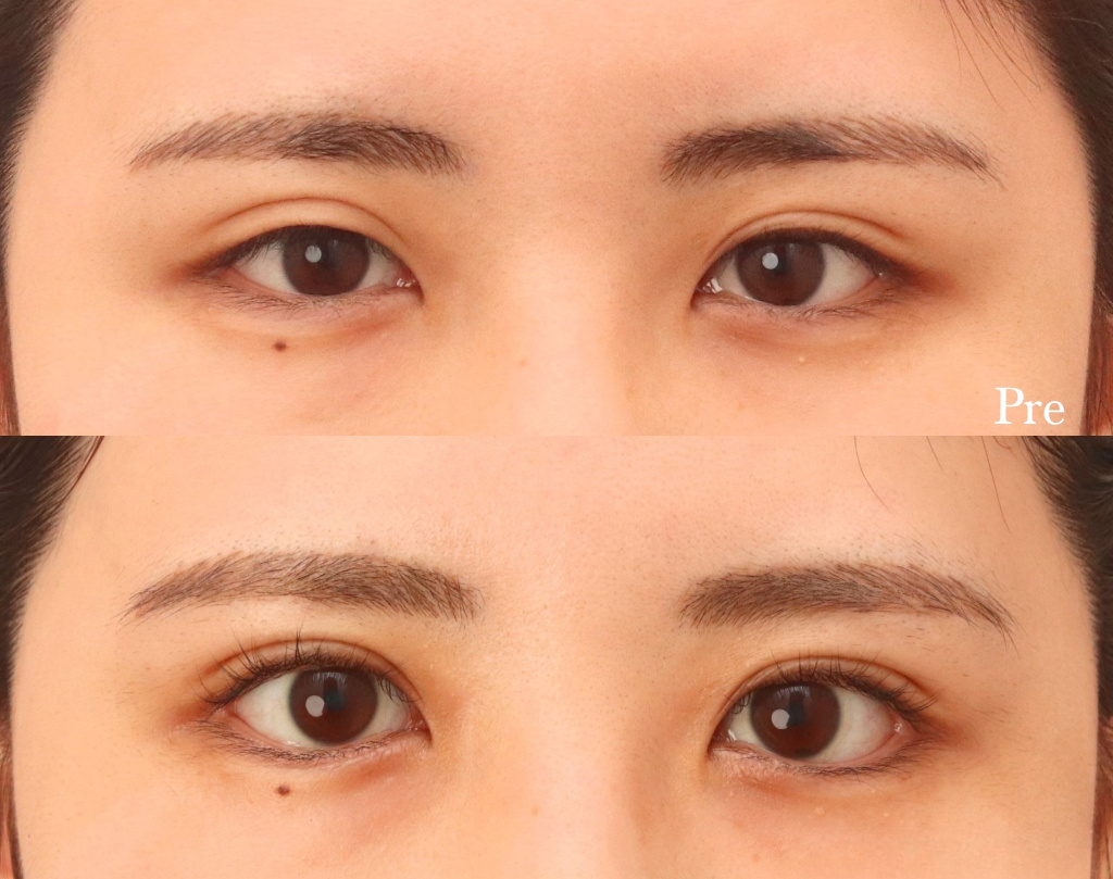 武汉眼部整形美容费用?眼部整形价格受哪些因素影响?插图 武汉眼部整形美容费用?眼部整形价格受哪些因素影响?插图