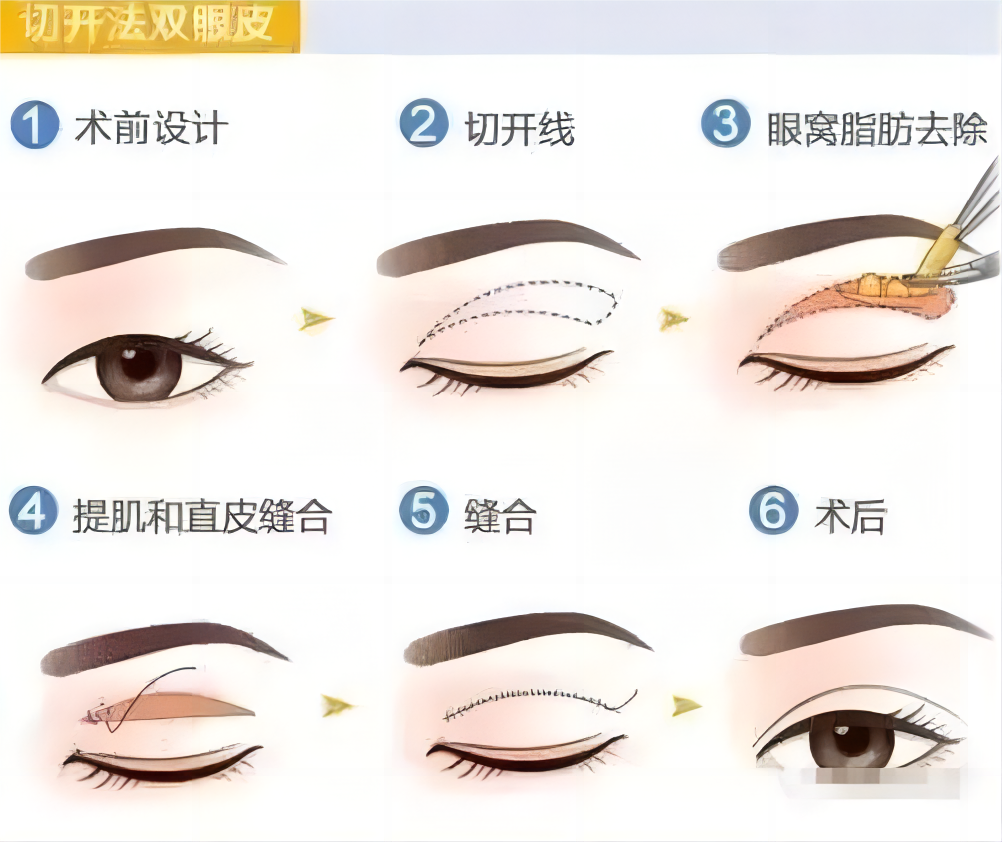 南京做全切双眼皮价格多少钱?如何选择合适的医院?插图 南京做全切双眼皮价格多少钱?如何选择合适的医院?插图