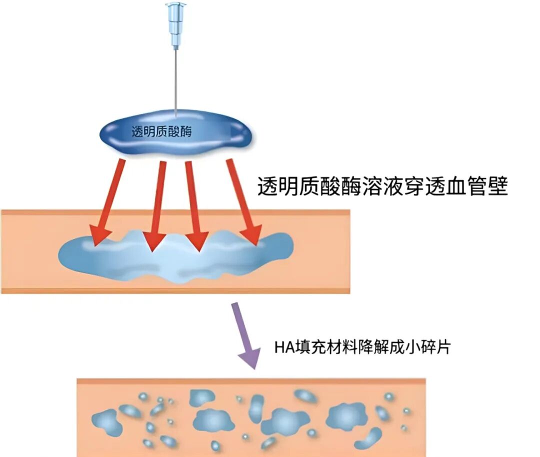 南京玻尿酸溶解价格需要多少钱?如何选择医院机构插图 南京玻尿酸溶解价格需要多少钱?如何选择医院机构插图