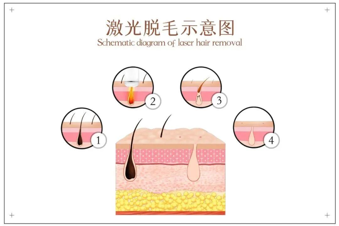 武汉激光脱毛预约指南 | 如何挑选合适的机构插图