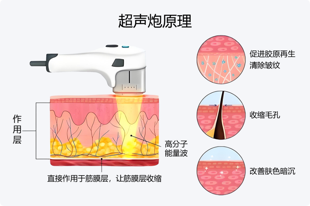 武汉超声炮哪家医院好?武汉超声炮治疗效果好的医院推荐插图 武汉超声炮哪家医院好?武汉超声炮治疗效果好的医院推荐插图