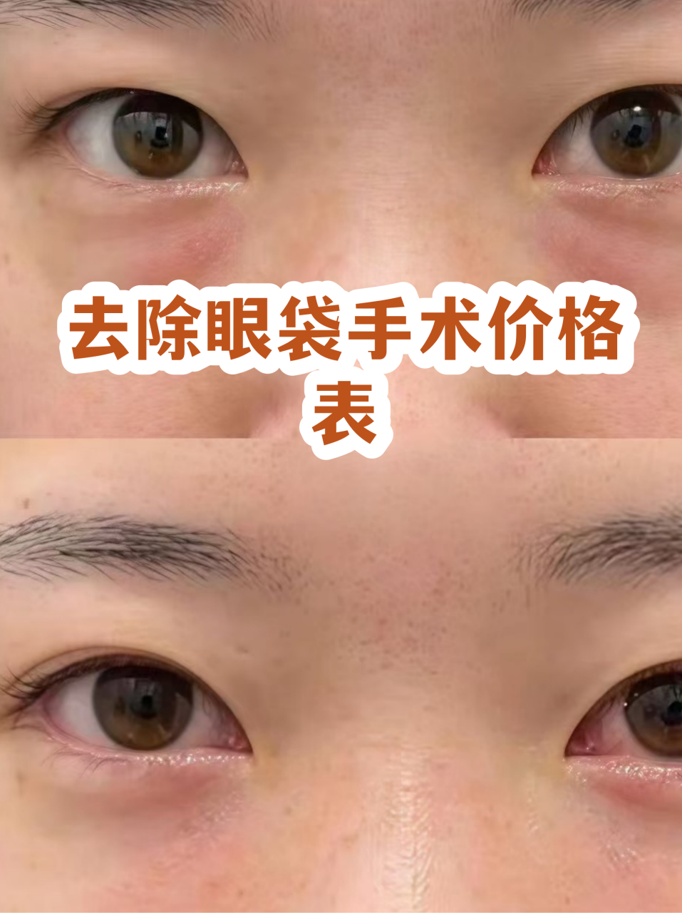 南京外切去眼袋价格多少钱？南京专业医院外切去眼袋手术费用指南插图1
