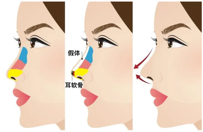耳软骨隆鼻手术多少钱左右？耳软骨隆鼻怎么取软骨？插图