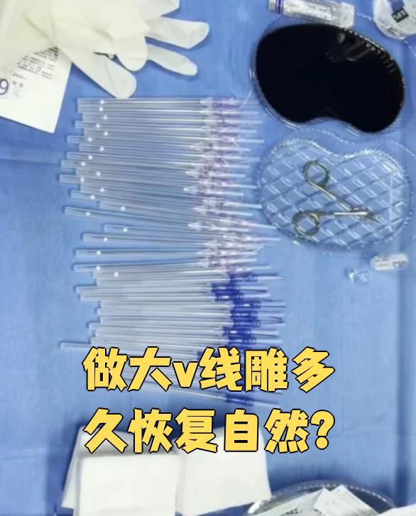 杭州做大V线雕价格多少钱?大V线雕手术费用及选择指南插图2 杭州做大V线雕价格多少钱?大V线雕手术费用及选择指南插图2