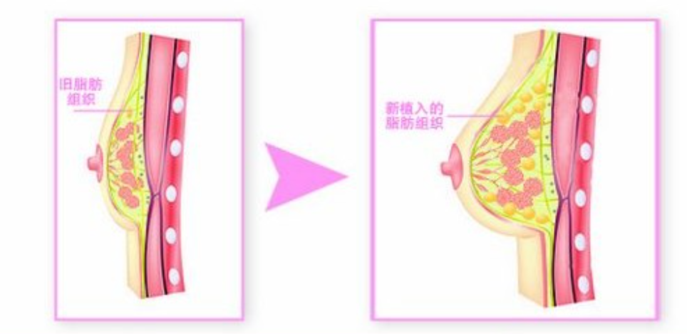 杭州自体脂肪隆胸价格多少钱?自体脂肪移植丰胸手术大致价格区间插图 杭州自体脂肪隆胸价格多少钱?自体脂肪移植丰胸手术大致价格区间插图