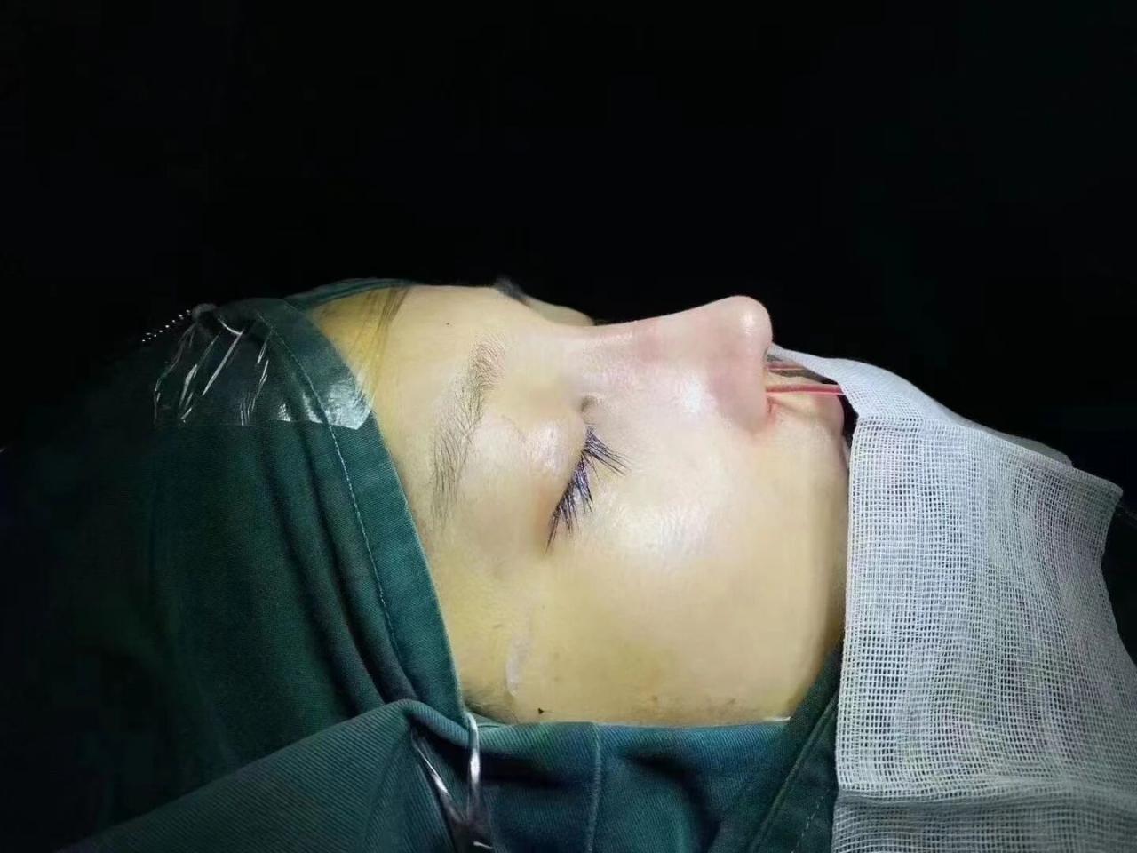 做了隆鼻手术多久恢复?隆鼻手术风险有多大啊?插图 做了隆鼻手术多久恢复?隆鼻手术风险有多大啊?插图