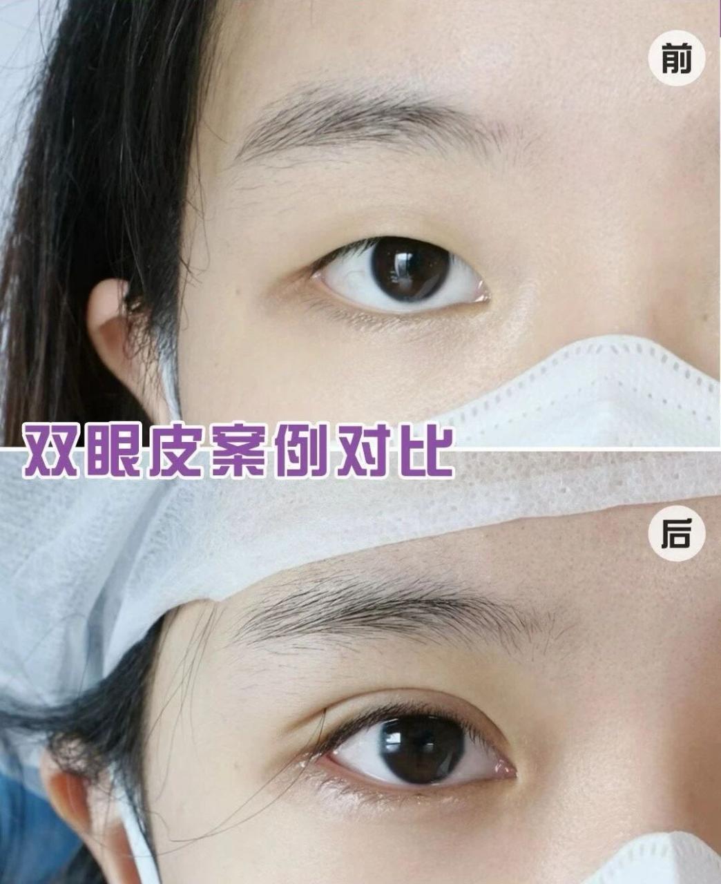 杭州双眼皮修复手术价格多少钱?插图1 杭州双眼皮修复手术价格多少钱?插图1