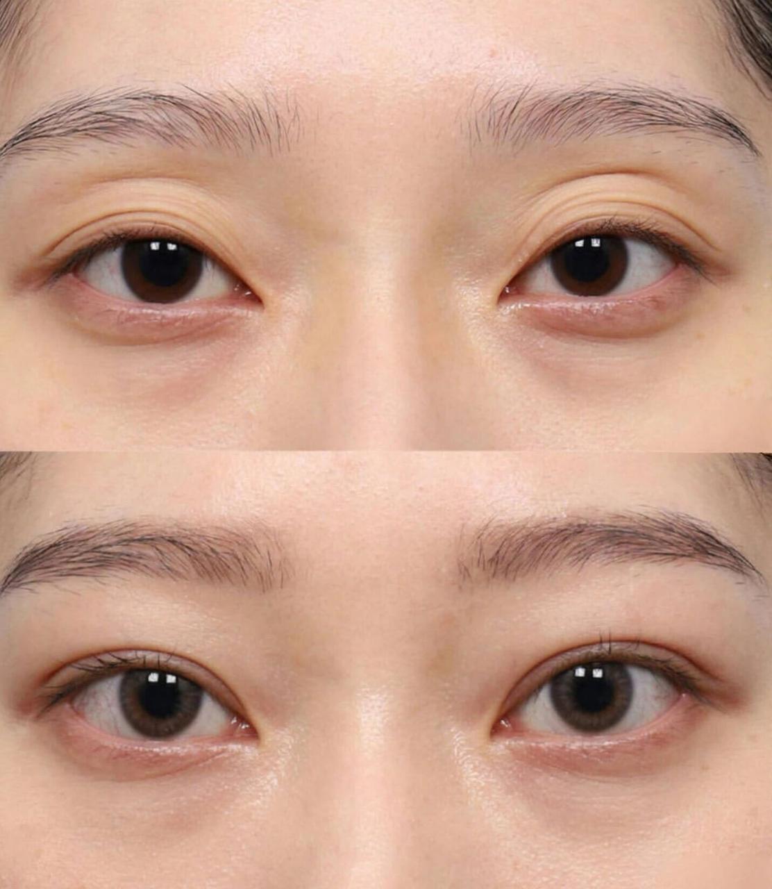 杭州眼修复手术预约指南 | 如何在杭州找到专业靠谱的眼修复医院插图1 杭州眼修复手术预约指南 | 如何在杭州找到专业靠谱的眼修复医院插图1