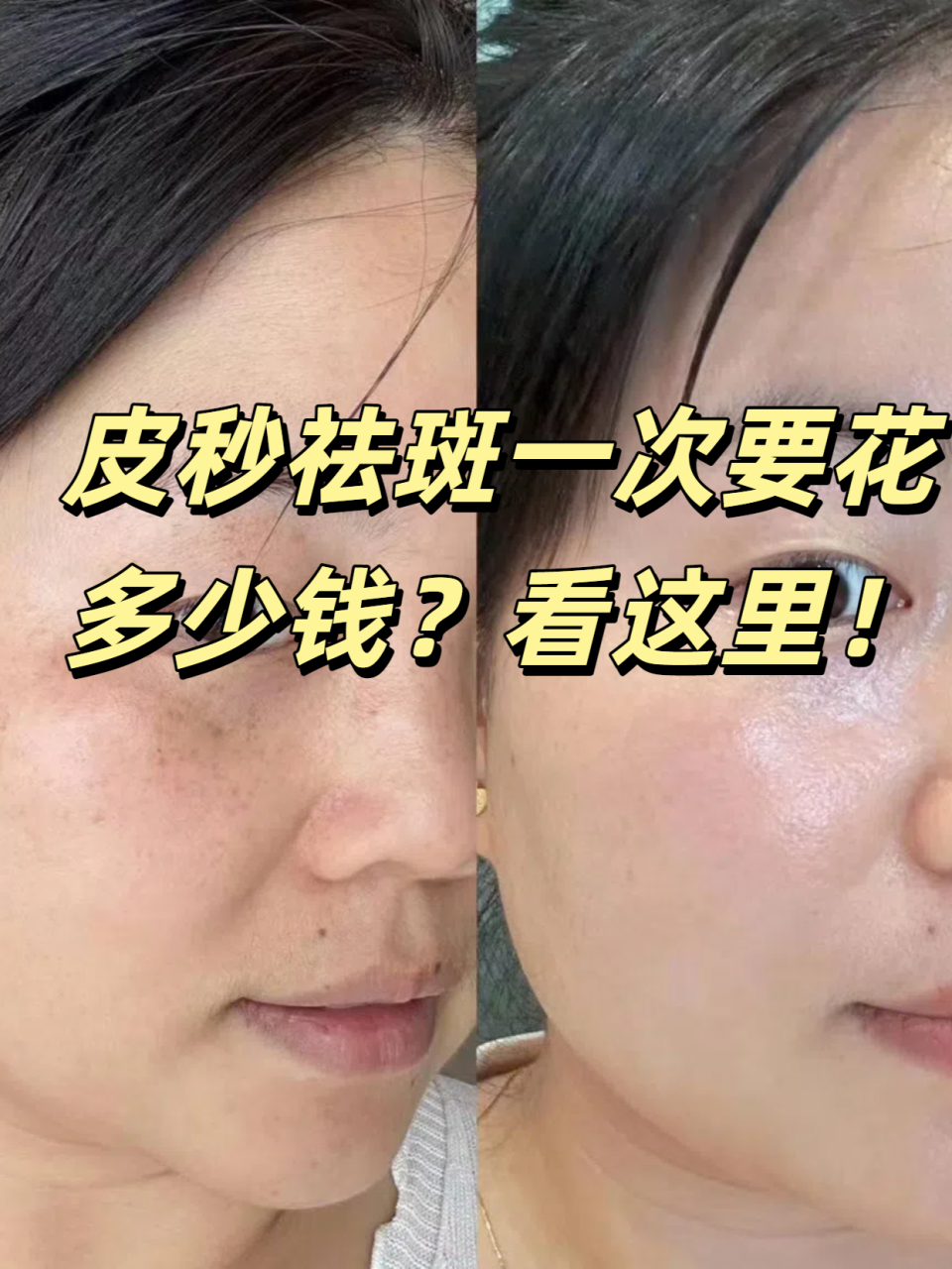 南京超皮秒祛斑价格多少钱?超皮秒去斑治疗费用全面了解插图1 南京超皮秒祛斑价格多少钱?超皮秒去斑治疗费用全面了解插图1