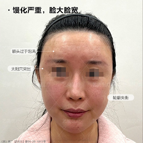 杭州馒化脸修复多少钱?杭州专业面部整形医院价格指南插图1 杭州馒化脸修复多少钱?杭州专业面部整形医院价格指南插图1